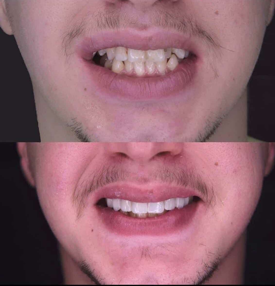 Fully Zirconia