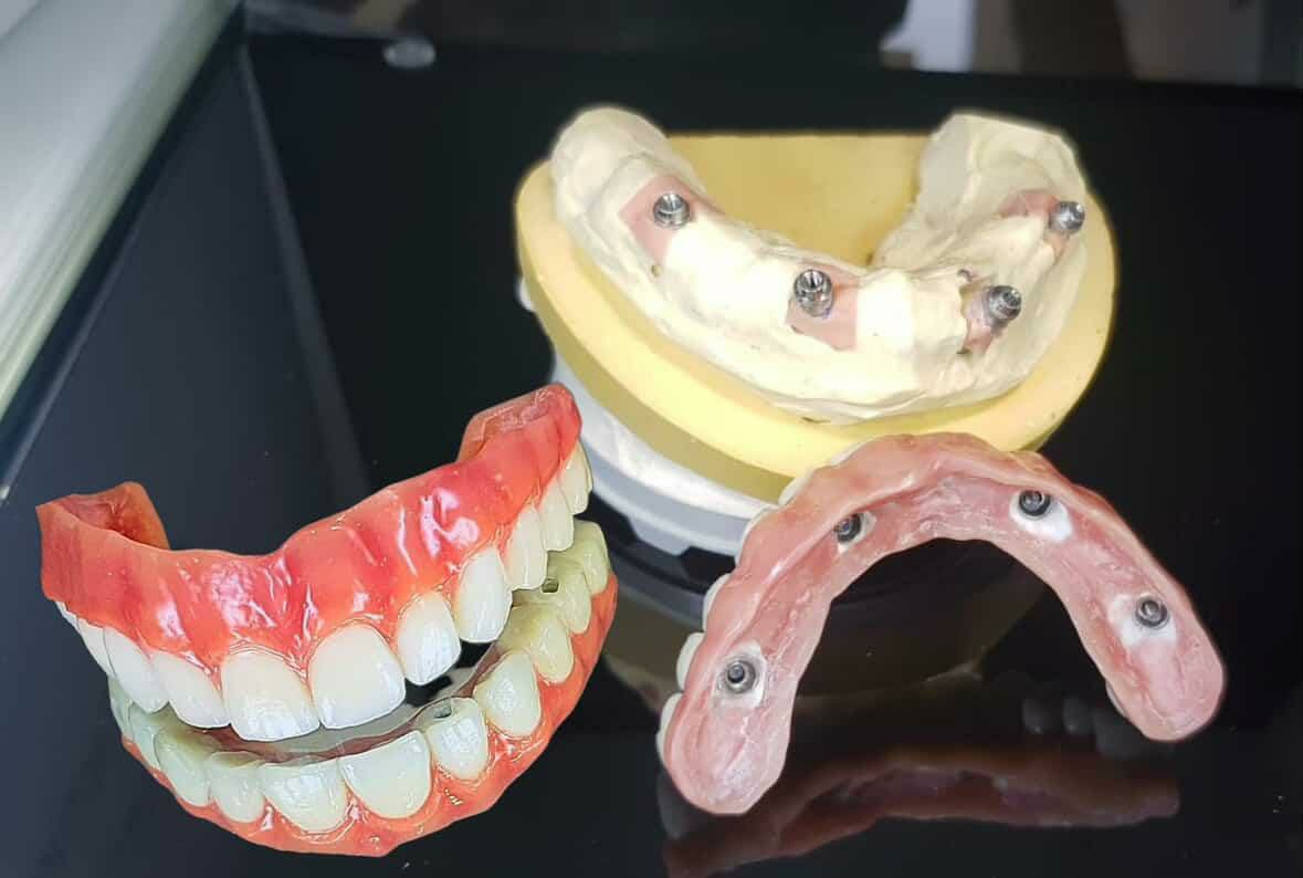 Implants